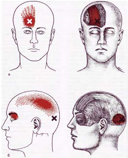Миофасциальные боли и дисфункции. Руководство по триггерным точкам (в 2-х томах). Том 1. Верхняя половина туловища - _00.jpg_21