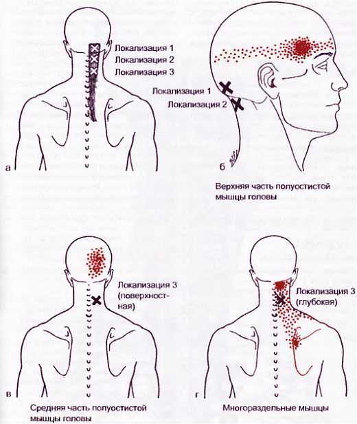 Миофасциальные боли и дисфункции. Руководство по триггерным точкам (в 2-х томах). Том 1. Верхняя половина туловища - _00.jpg_22