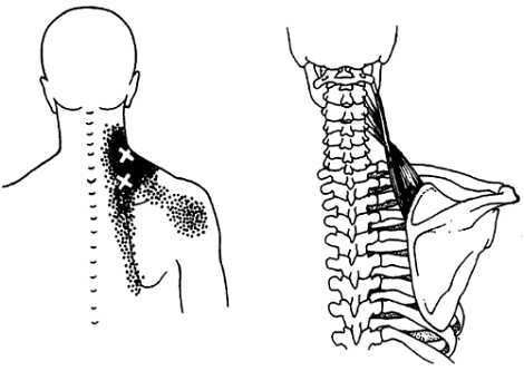 Миофасциальные боли и дисфункции. Руководство по триггерным точкам (в 2-х томах). Том 1. Верхняя половина туловища - _00.jpg_28