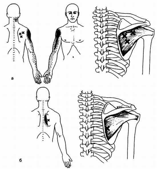 Миофасциальные боли и дисфункции. Руководство по триггерным точкам (в 2-х томах). Том 1. Верхняя половина туловища - _00.jpg_32