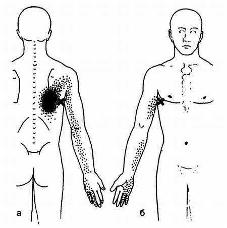 Миофасциальные боли и дисфункции. Руководство по триггерным точкам (в 2-х томах). Том 1. Верхняя половина туловища - _00.jpg_33