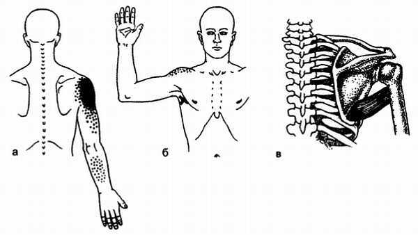 Миофасциальные боли и дисфункции. Руководство по триггерным точкам (в 2-х томах). Том 1. Верхняя половина туловища - _00.jpg_34