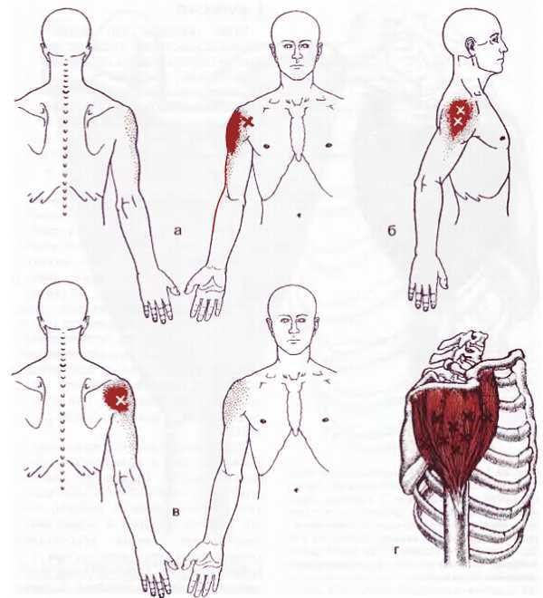 Миофасциальные боли и дисфункции. Руководство по триггерным точкам (в 2-х томах). Том 1. Верхняя половина туловища - _00.jpg_36