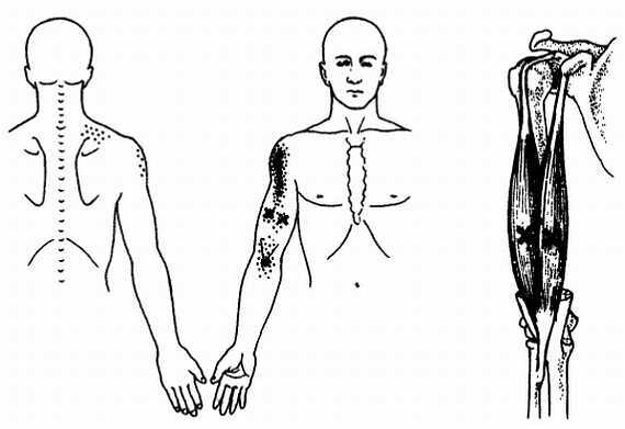Миофасциальные боли и дисфункции. Руководство по триггерным точкам (в 2-х томах). Том 1. Верхняя половина туловища - _00.jpg_37