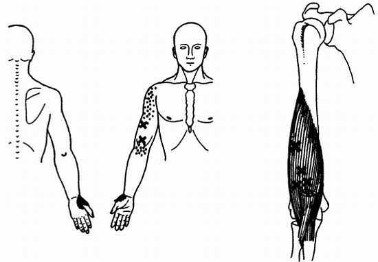 Миофасциальные боли и дисфункции. Руководство по триггерным точкам (в 2-х томах). Том 1. Верхняя половина туловища - _00.jpg_39