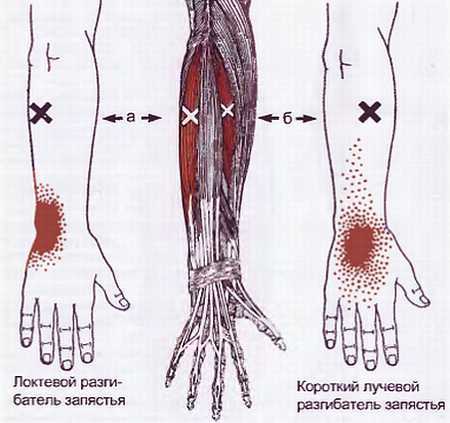 Миофасциальные боли и дисфункции. Руководство по триггерным точкам (в 2-х томах). Том 1. Верхняя половина туловища - _00.jpg_40