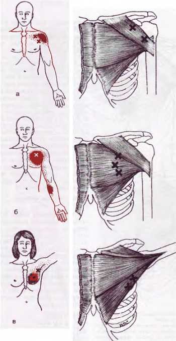 Миофасциальные боли и дисфункции. Руководство по триггерным точкам (в 2-х томах). Том 1. Верхняя половина туловища - _00.jpg_46