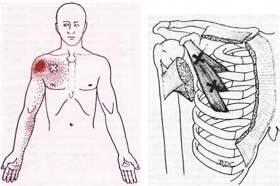 Миофасциальные боли и дисфункции. Руководство по триггерным точкам (в 2-х томах). Том 1. Верхняя половина туловища - _00.jpg_48