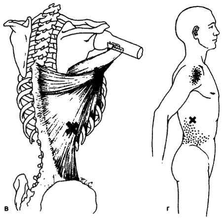 Миофасциальные боли и дисфункции. Руководство по триггерным точкам (в 2-х томах). Том 1. Верхняя половина туловища - _01.jpg_26