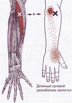 Миофасциальные боли и дисфункции. Руководство по триггерным точкам (в 2-х томах). Том 1. Верхняя половина туловища - _01.jpg_32