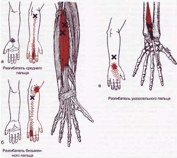 Миофасциальные боли и дисфункции. Руководство по триггерным точкам (в 2-х томах). Том 1. Верхняя половина туловища - _01.jpg_34