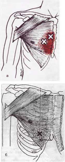 Миофасциальные боли и дисфункции. Руководство по триггерным точкам (в 2-х томах). Том 1. Верхняя половина туловища - _01.jpg_38