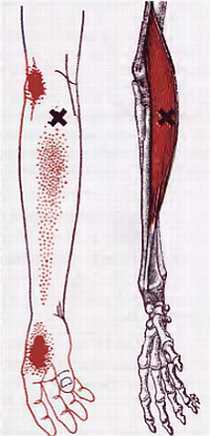 Миофасциальные боли и дисфункции. Руководство по триггерным точкам (в 2-х томах). Том 1. Верхняя половина туловища - _02.jpg_32