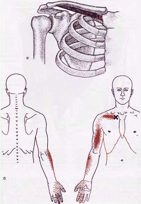 Миофасциальные боли и дисфункции. Руководство по триггерным точкам (в 2-х томах). Том 1. Верхняя половина туловища - _02.jpg_39