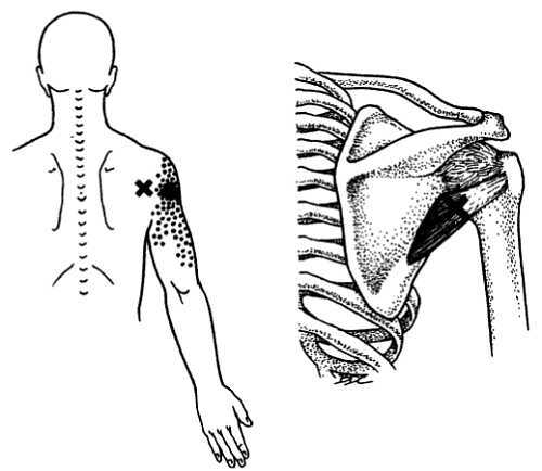 Миофасциальные боли и дисфункции. Руководство по триггерным точкам (в 2-х томах). Том 1. Верхняя половина туловища - _06.jpg_16