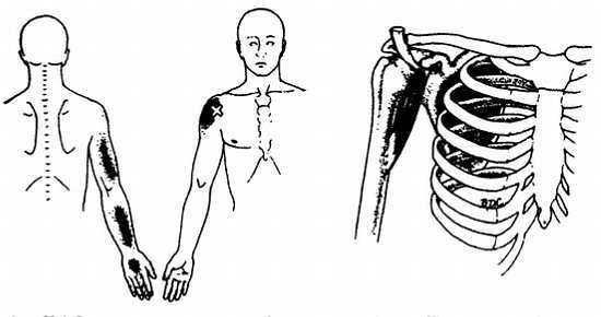 Миофасциальные боли и дисфункции. Руководство по триггерным точкам (в 2-х томах). Том 1. Верхняя половина туловища - _06.jpg_19
