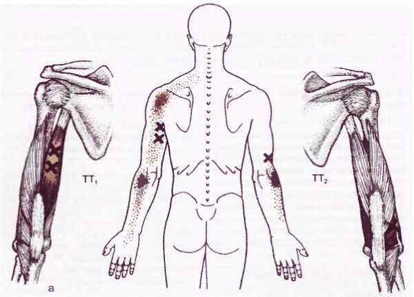 Миофасциальные боли и дисфункции. Руководство по триггерным точкам (в 2-х томах). Том 1. Верхняя половина туловища - _06.jpg_21
