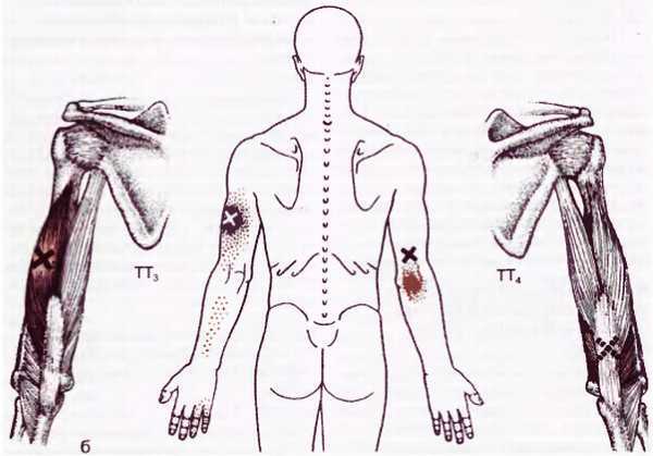 Миофасциальные боли и дисфункции. Руководство по триггерным точкам (в 2-х томах). Том 1. Верхняя половина туловища - _07.jpg_16