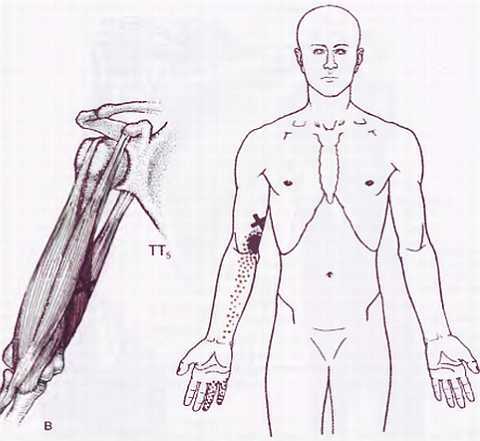 Миофасциальные боли и дисфункции. Руководство по триггерным точкам (в 2-х томах). Том 1. Верхняя половина туловища - _08.jpg_11