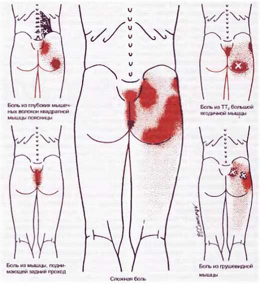 Миофасциальные боли и дисфункции. Руководство по триггерным точкам (в 2-х томах). Том 1. Верхняя половина туловища - _10.jpg_11