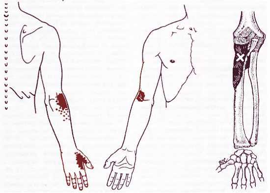 Миофасциальные боли и дисфункции. Руководство по триггерным точкам (в 2-х томах). Том 1. Верхняя половина туловища - _12.jpg_4