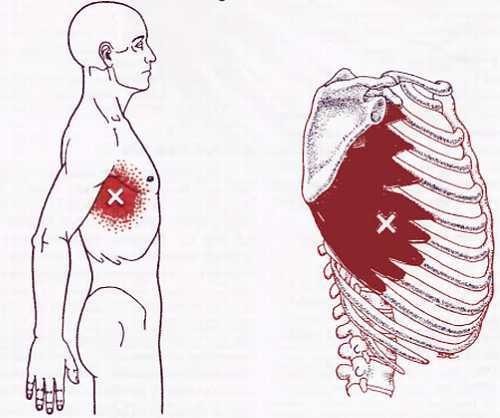 Миофасциальные боли и дисфункции. Руководство по триггерным точкам (в 2-х томах). Том 1. Верхняя половина туловища - _01.jpg_43