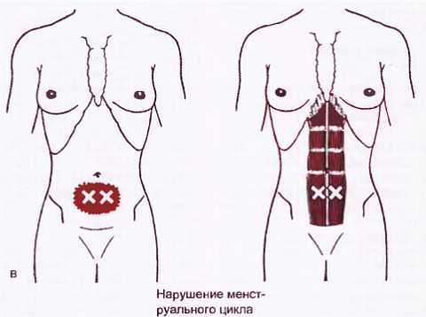Миофасциальные боли и дисфункции. Руководство по триггерным точкам (в 2-х томах). Том 1. Верхняя половина туловища - _02.jpg_45