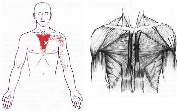 Миофасциальные боли и дисфункции. Руководство по триггерным точкам (в 2-х томах). Том 1. Верхняя половина туловища - _07.jpg_21