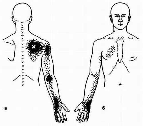 Миофасциальные боли и дисфункции. Руководство по триггерным точкам (в 2-х томах). Том 1. Верхняя половина туловища - _07.jpg_23