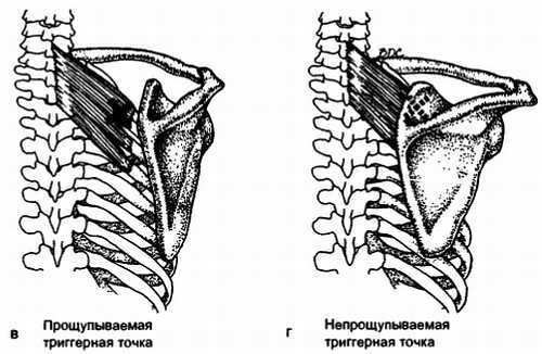 Миофасциальные боли и дисфункции. Руководство по триггерным точкам (в 2-х томах). Том 1. Верхняя половина туловища - _08.jpg_16