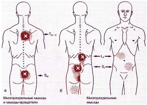 Миофасциальные боли и дисфункции. Руководство по триггерным точкам (в 2-х томах). Том 1. Верхняя половина туловища - _08.jpg_17