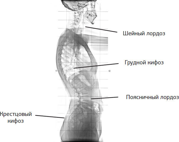 S-образный сколиоз