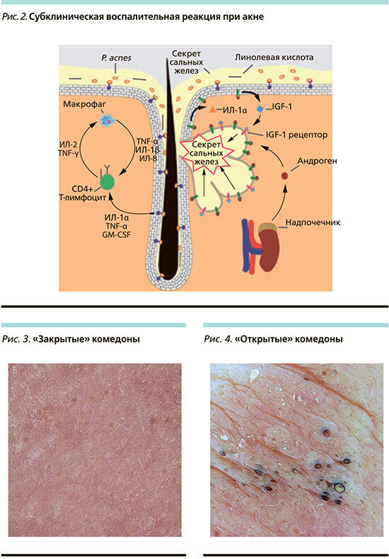 Всё об акне с позиции медицины - i_004.jpg