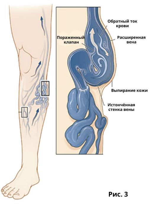 Краткие рекомендации пациентам с варикозной болезнью - _2.jpg