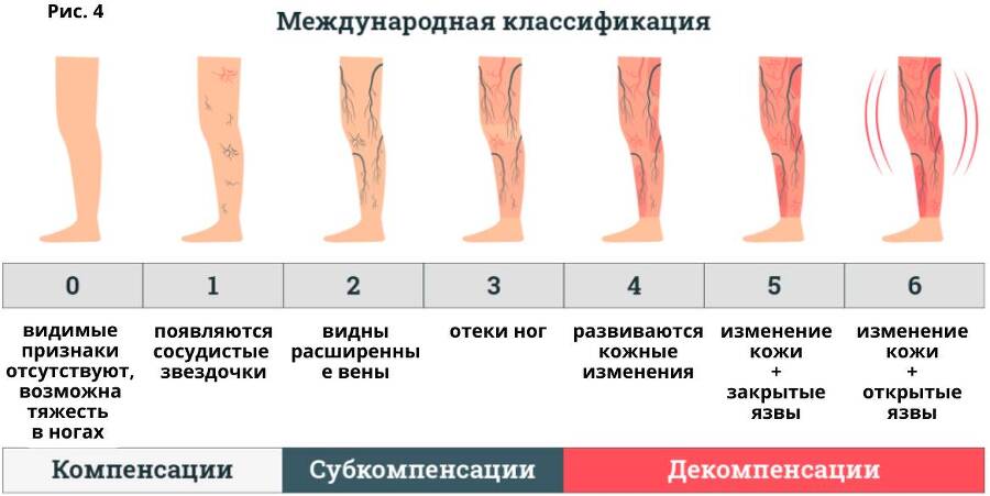 Краткие рекомендации пациентам с варикозной болезнью - _3.jpg