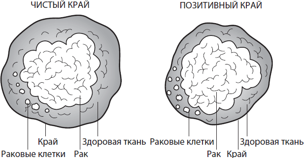 Поговорим о раке груди. Полное руководство для онкопациентов и их близких - i_003.png