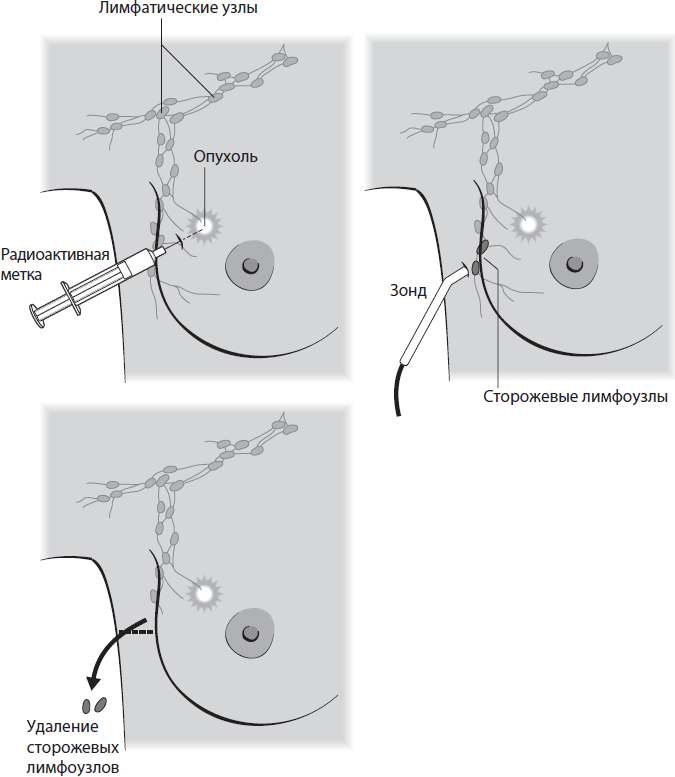 Поговорим о раке груди. Полное руководство для онкопациентов и их близких - i_010.png