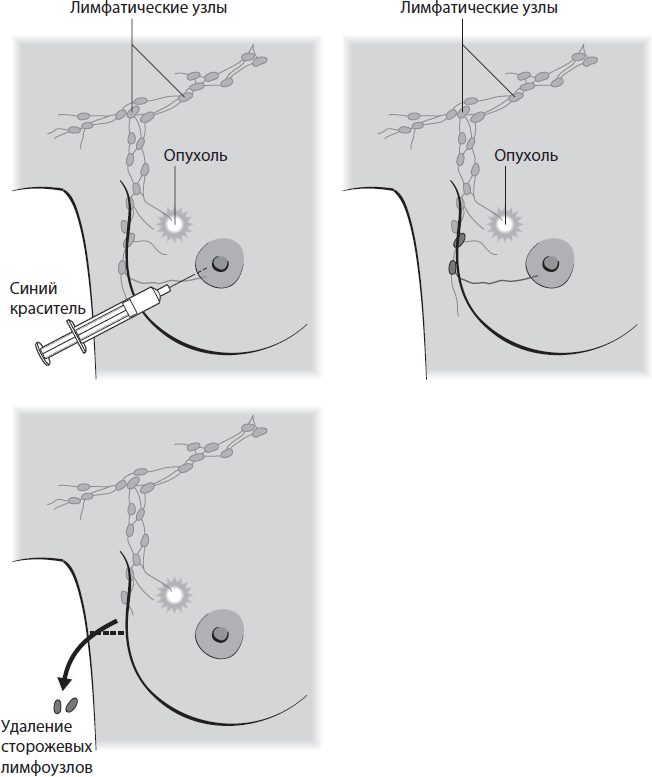 Поговорим о раке груди. Полное руководство для онкопациентов и их близких - i_011.png