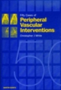 Fifty Cases of Peripheral Vascular Interventions